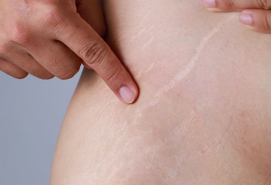 krim penghilang stretch mark