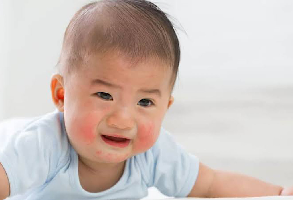 ada bintik merah setelah demam pada bayi