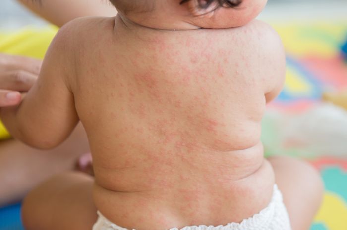 Roseola infantum pada bayi