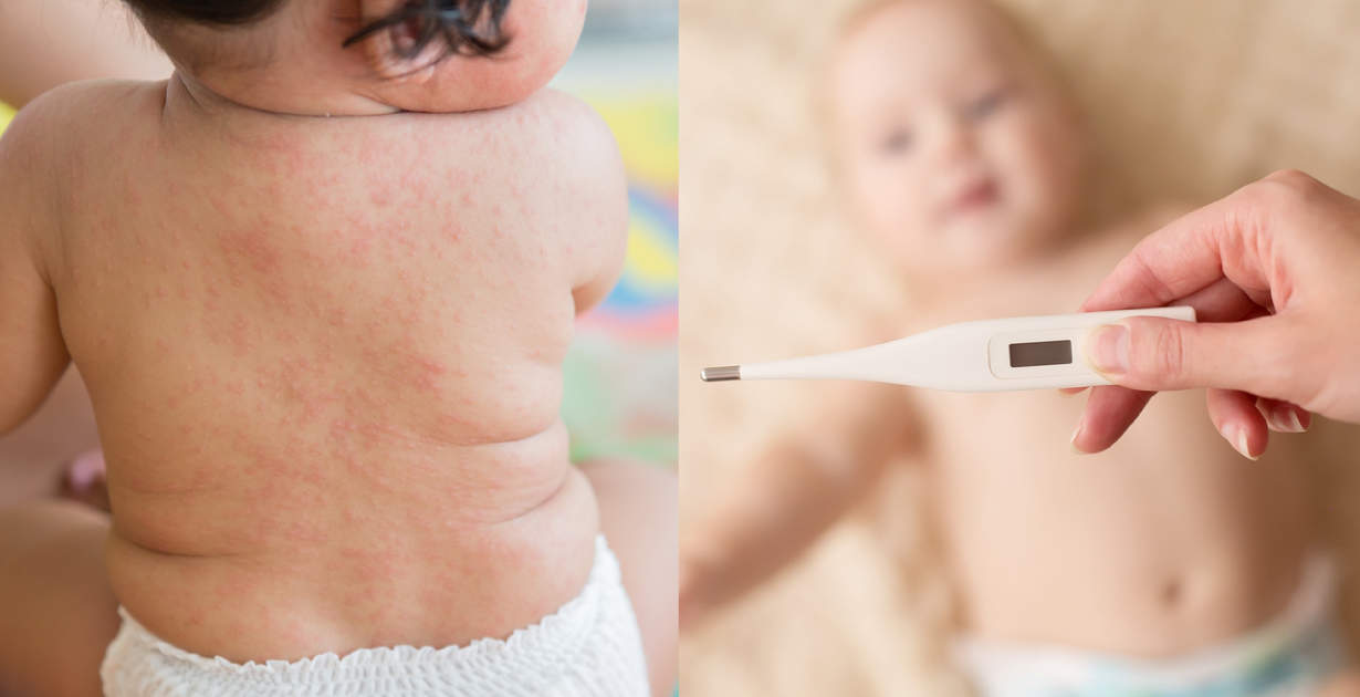 Roseola infantum pada bayi