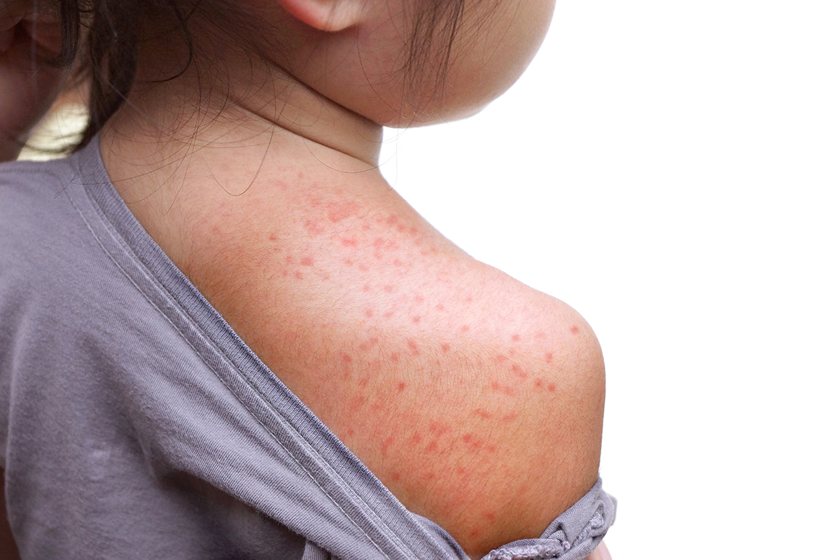 roseola infantum