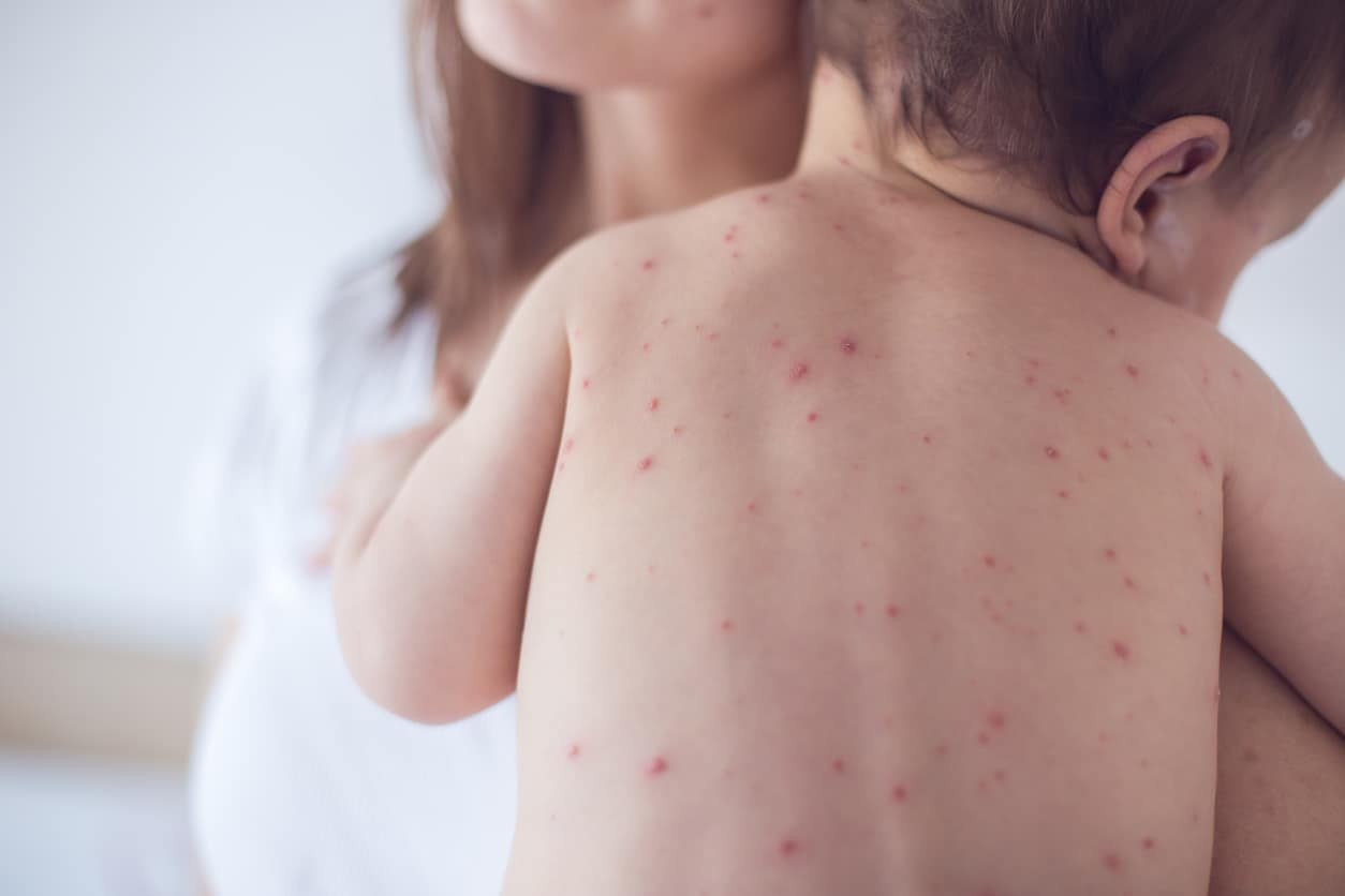 roseola infantum, bolehkah mandi?