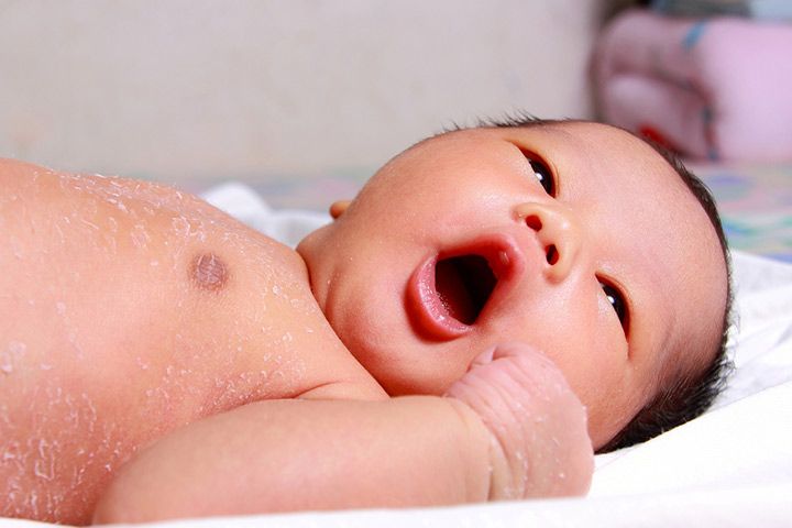 Kulit Bayi Mengelupas 