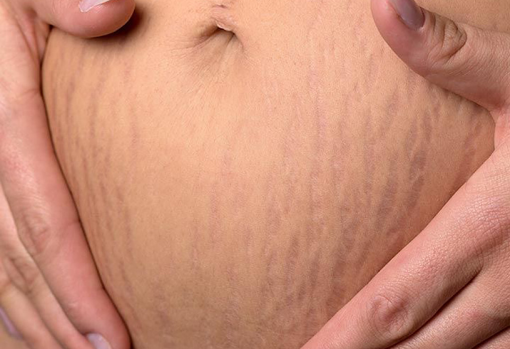 stretch mark ibu hamil pada ibu hamil tidak bisa hilang