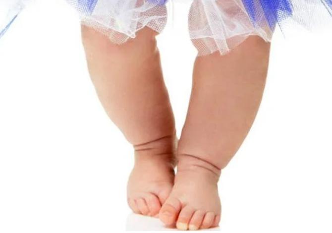 5 Penyebab Kaki Bayi Berbentuk Huruf O