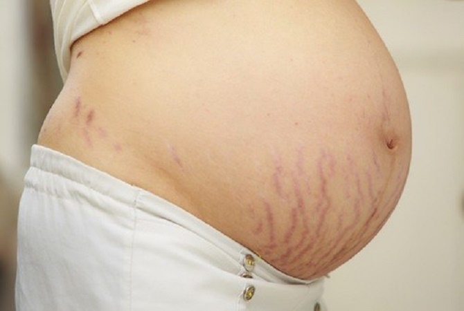 Fenomena Stretch Marks