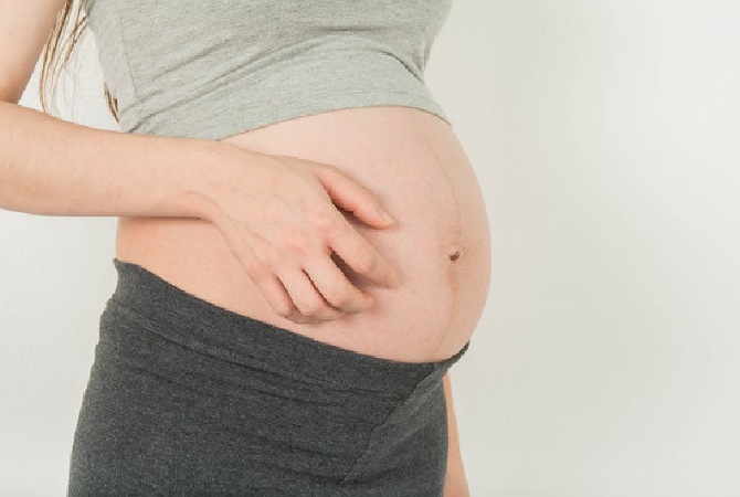 Hilangkan Stretch Mark Pasca Melahirkan, Begini Caranya