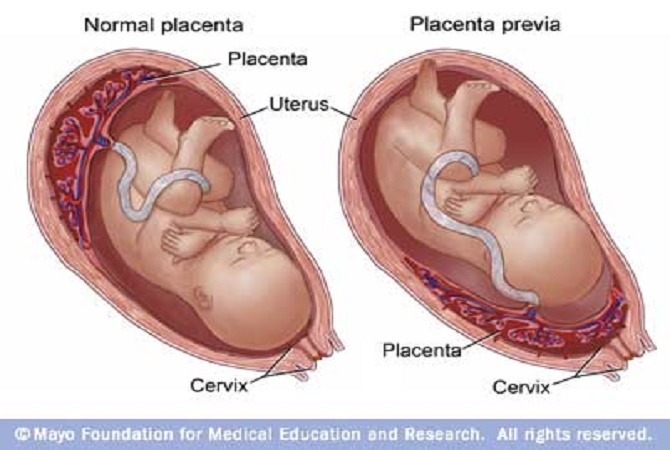 Yuk Kenali Plasenta Previa