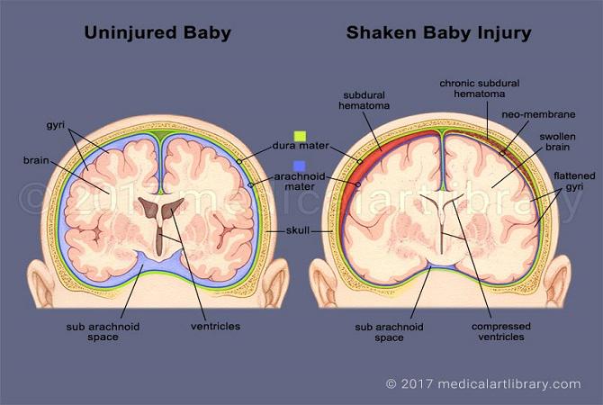 Yuk Moms Kenali Shaken Baby Syndrome