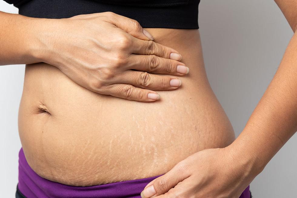 Benarkah Penyebab Stretch Mark pada Pria dan Wanita Sama?