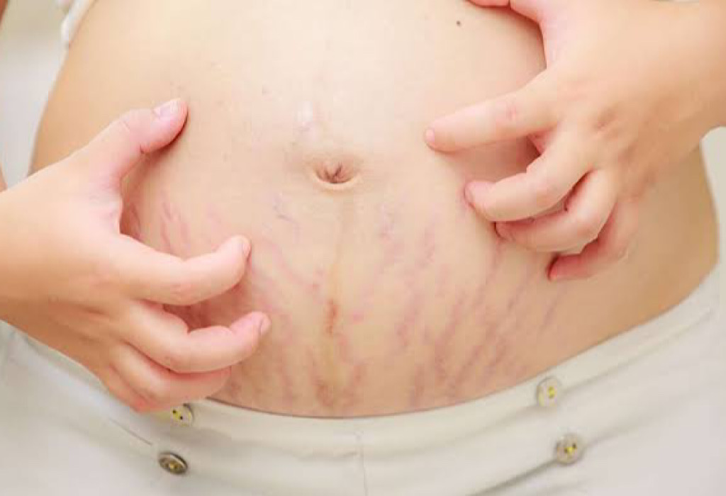 Penyebab Stretch Mark Pada Ibu Hamil Terasa Perih & Cara Mengobatinya