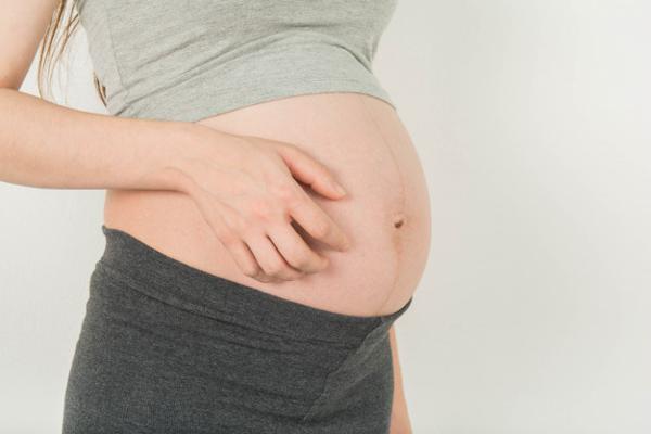 15 Cara Menghilangkan Stretch Mark Secara Alami dan Cepat