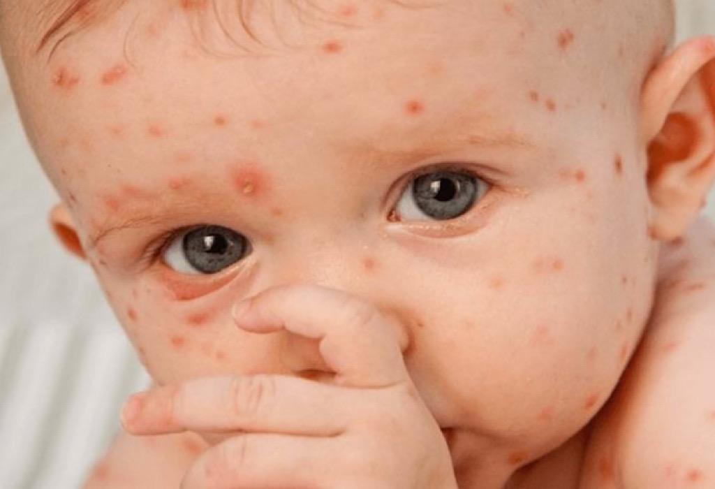 Menangani Herpes Zoster Pada Anak: Waspadai Gejalanya