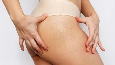 5 Tanda Tubuh Ibu Hamil Akan Mengalami Stretch Mark, Cegah Sebelum Terlambat!