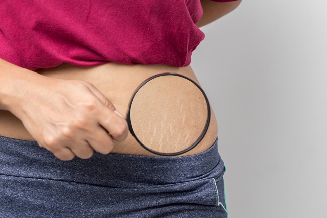 Cara Menghilangkan Stretch Mark secara Alami dari Rumah