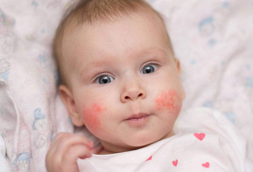 Ini Gambar Bintik Merah Akibat Alergi Susu Sapi Pada Bayi