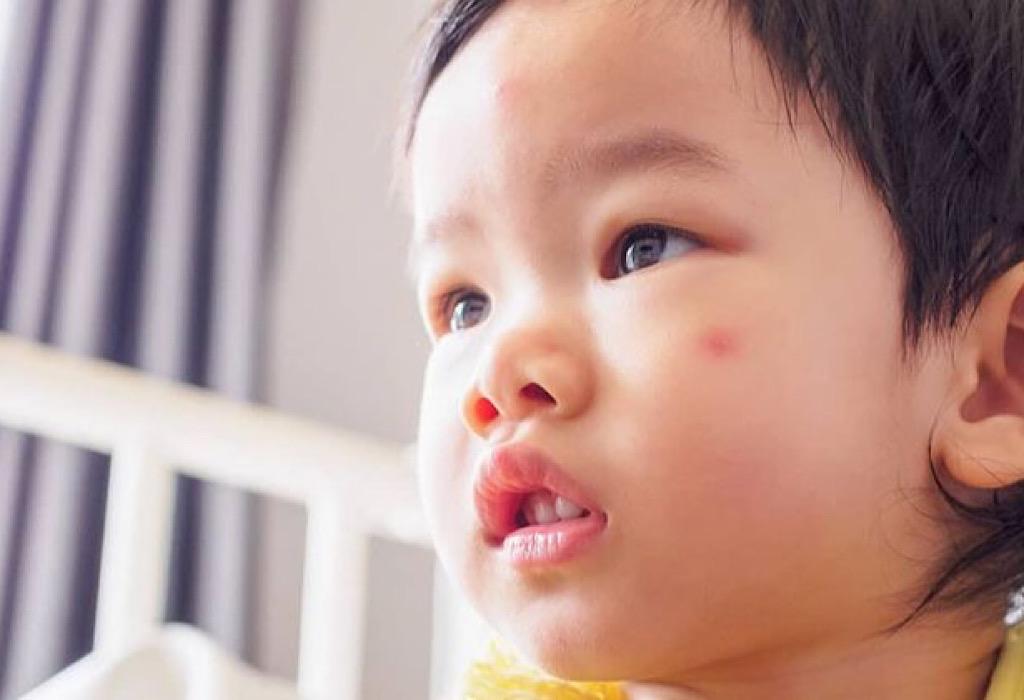 Atasi Anak Sakit Kulit Karena Jamur? Ini 5 Obat Jamur Kulit Untuk Bayi