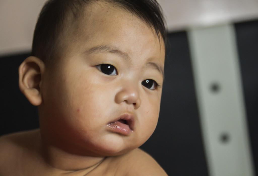 Cara Mengatasi Biduran Pada Bayi Secara Ampuh, Ketahui Juga Penyebabnya!