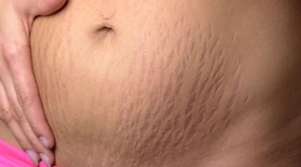 10 Cara Menghilangkan Stretch Mark Saat Hamil Secara Alami